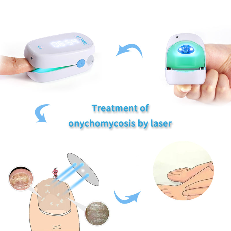 Toenail Fungus Laser Treatment At-Home Fast-Acting Onychomycosis Relief Device