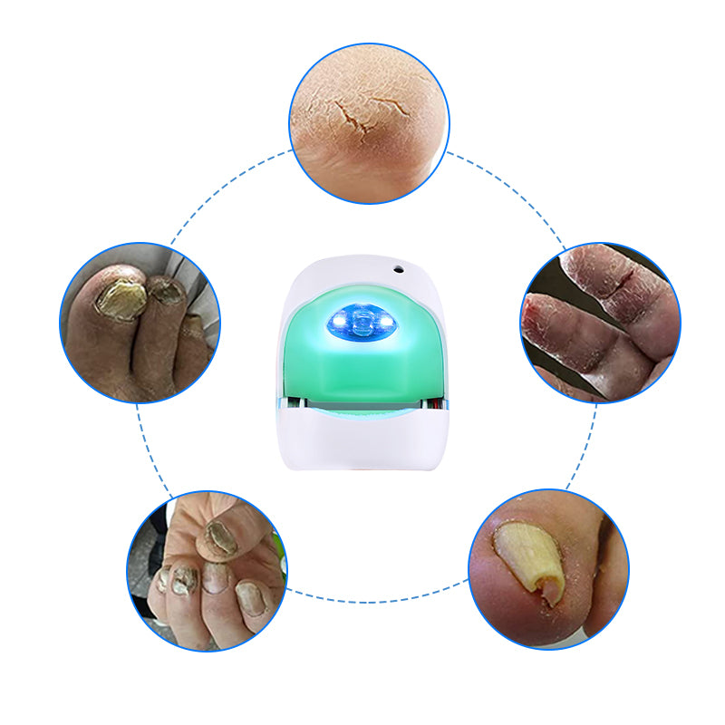 Onychomycosis Treatment Nail Fungus Laser For Ingrown Toenail Treatment