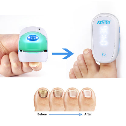 Onychomycosis Treatment Nail Fungus Laser For Ingrown Toenail Treatment