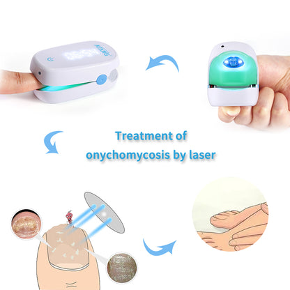 Toenail Fungus Laser Treatment At-Home Fast-Acting Onychomycosis Relief Device