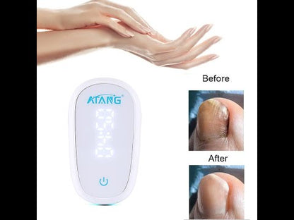 Onychomycosis Treatment Nail Fungus Laser For Ingrown Toenail Treatment